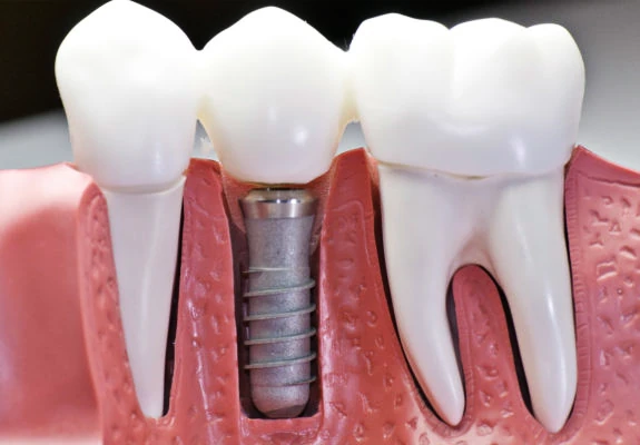 Foto de uma amostra de resina de dentista com três dentes sendo o do meio um implante.